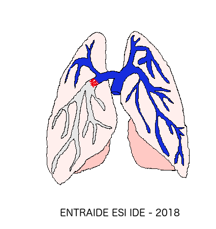 L'embolie Pulmonaire (EP) - ENTRAIDE ESI IDE